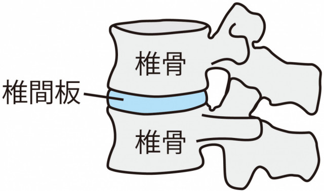頚椎椎間板ヘルニアとは?