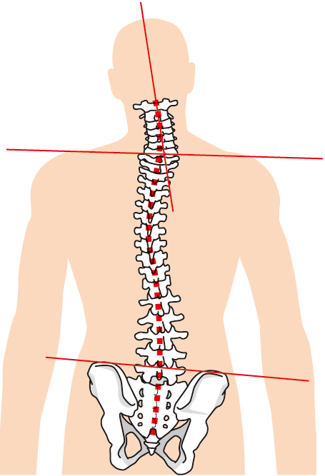 当院の脊柱管狭窄症へのアプローチとは