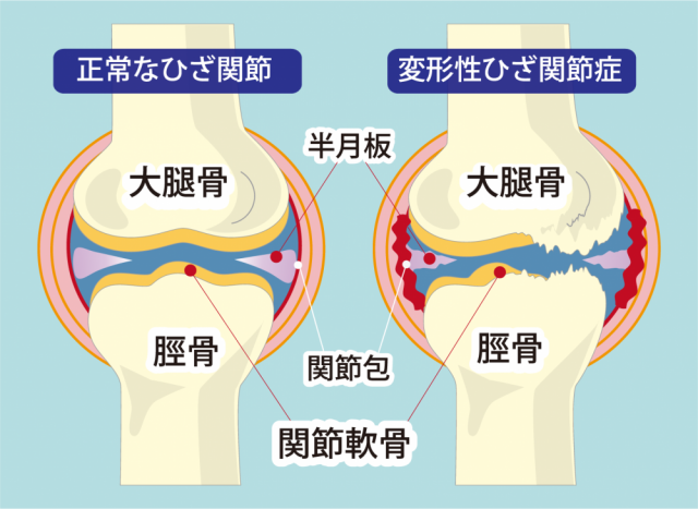 変形性膝関節症とは