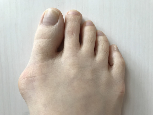 外反母趾とは