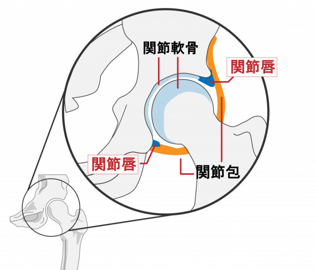 変形性股関節症とは