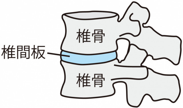 腰椎すべり症とは